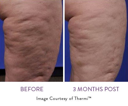 thermi smooth before and after