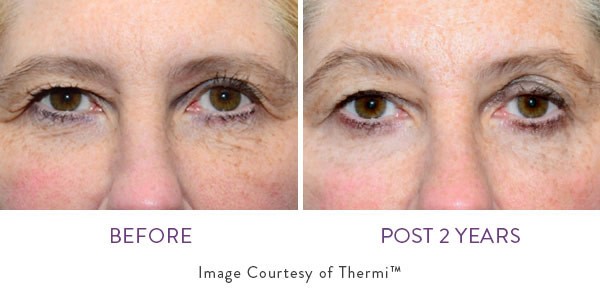 thermi smooth before and after