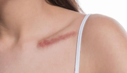 Scar and Texture Correction in Little Rock, Arkansas